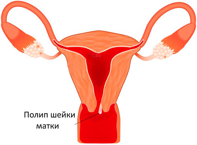 Полипы шейки матки